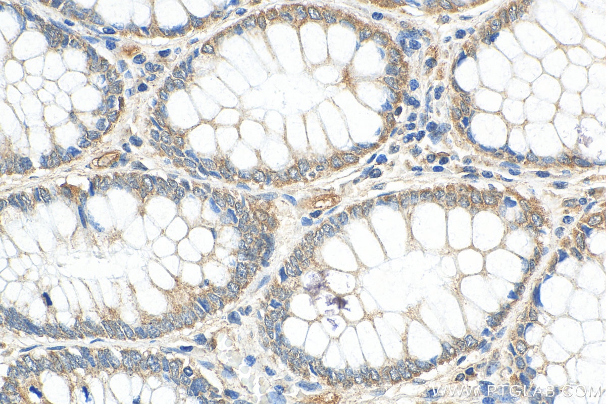 Immunohistochemistry (IHC) staining of human colon cancer tissue using NXT2 Polyclonal antibody (12136-1-AP)