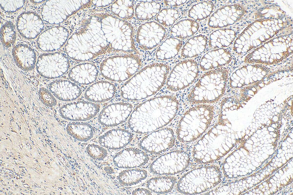 Immunohistochemistry (IHC) staining of human colon cancer tissue using NXT2 Polyclonal antibody (12136-1-AP)
