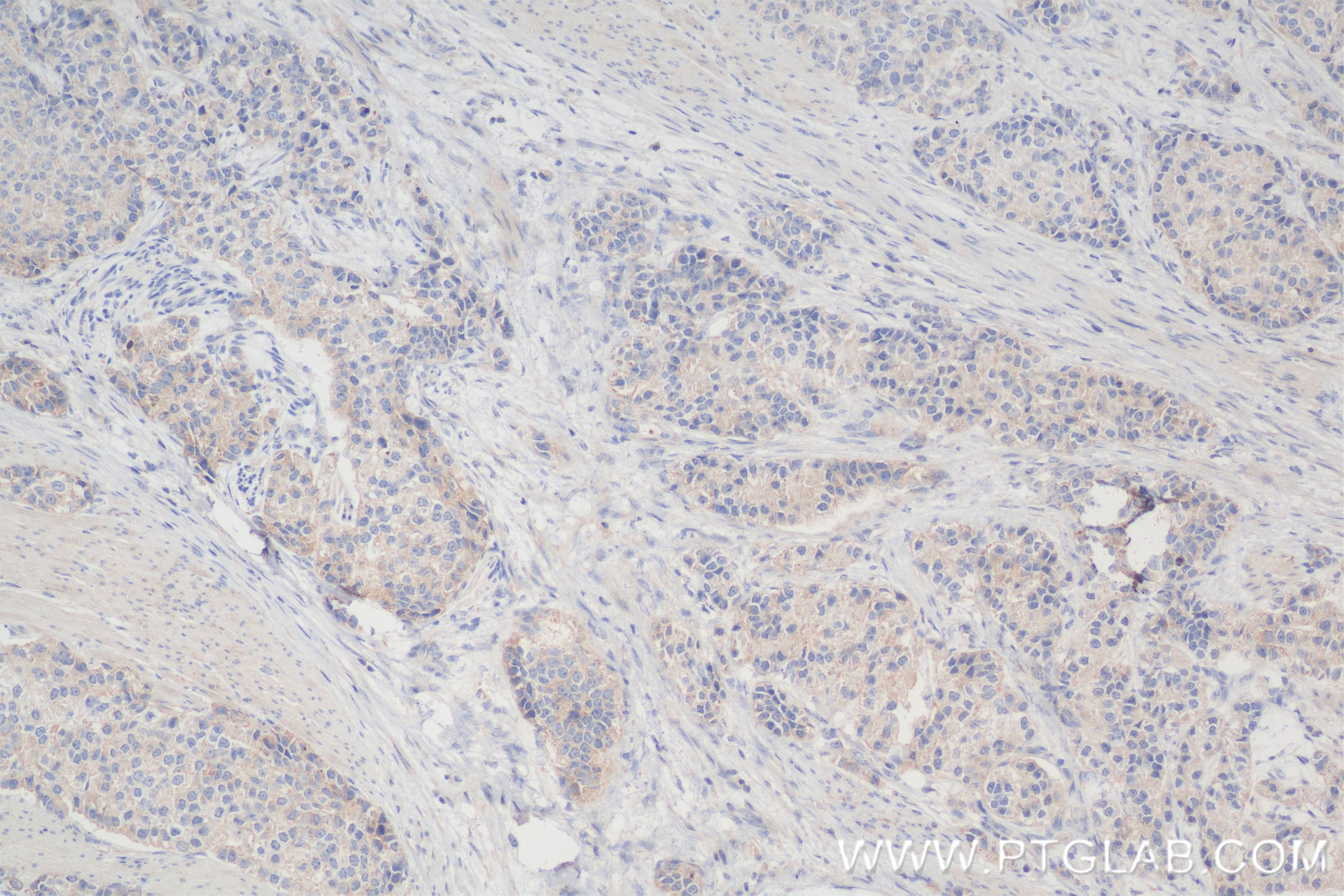 Immunohistochemistry (IHC) staining of human stomach cancer tissue using NY-ESO-1 Recombinant antibody (85355-1-RR)