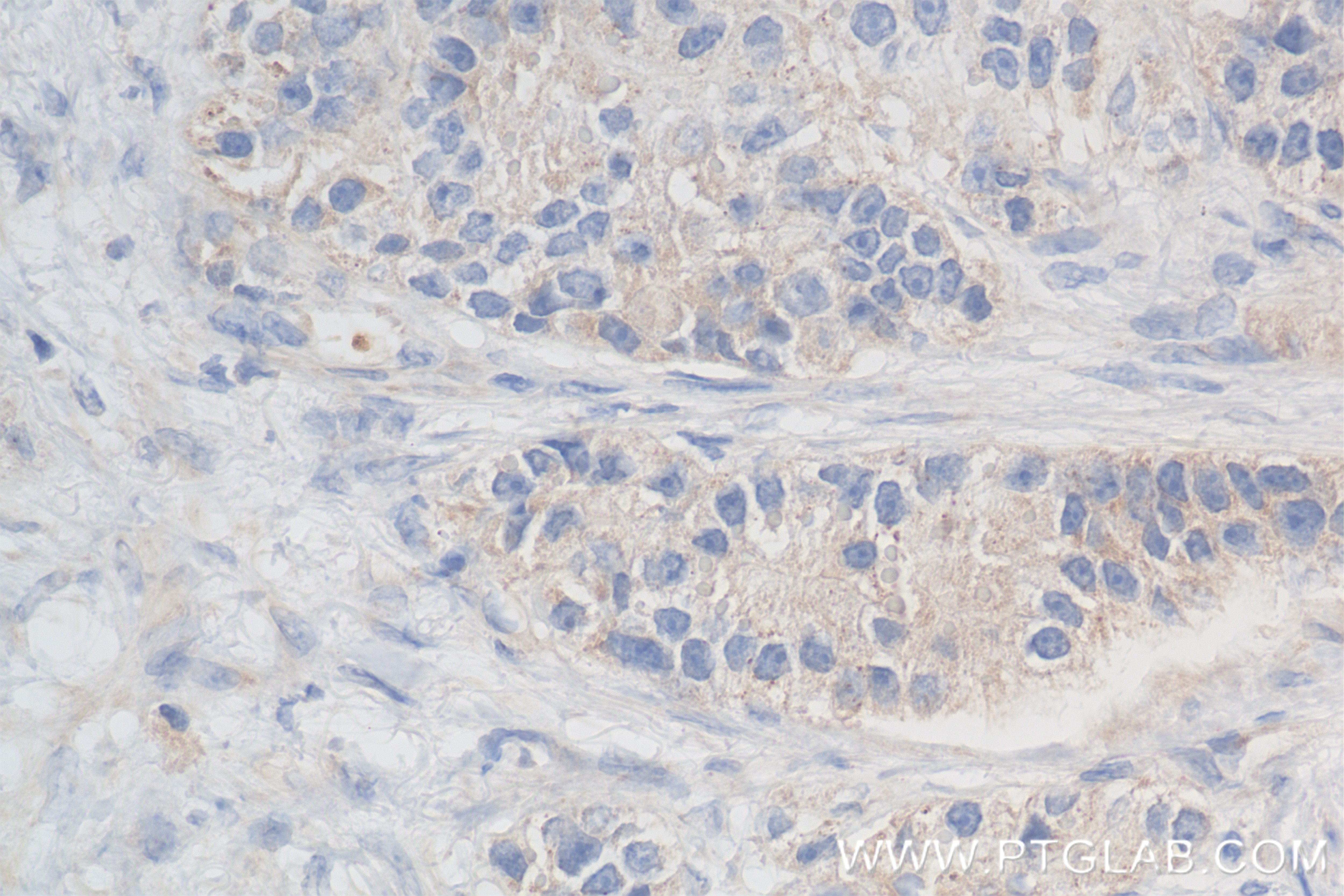 Immunohistochemistry (IHC) staining of human stomach cancer tissue using NY-ESO-1 Recombinant antibody (85355-1-RR)