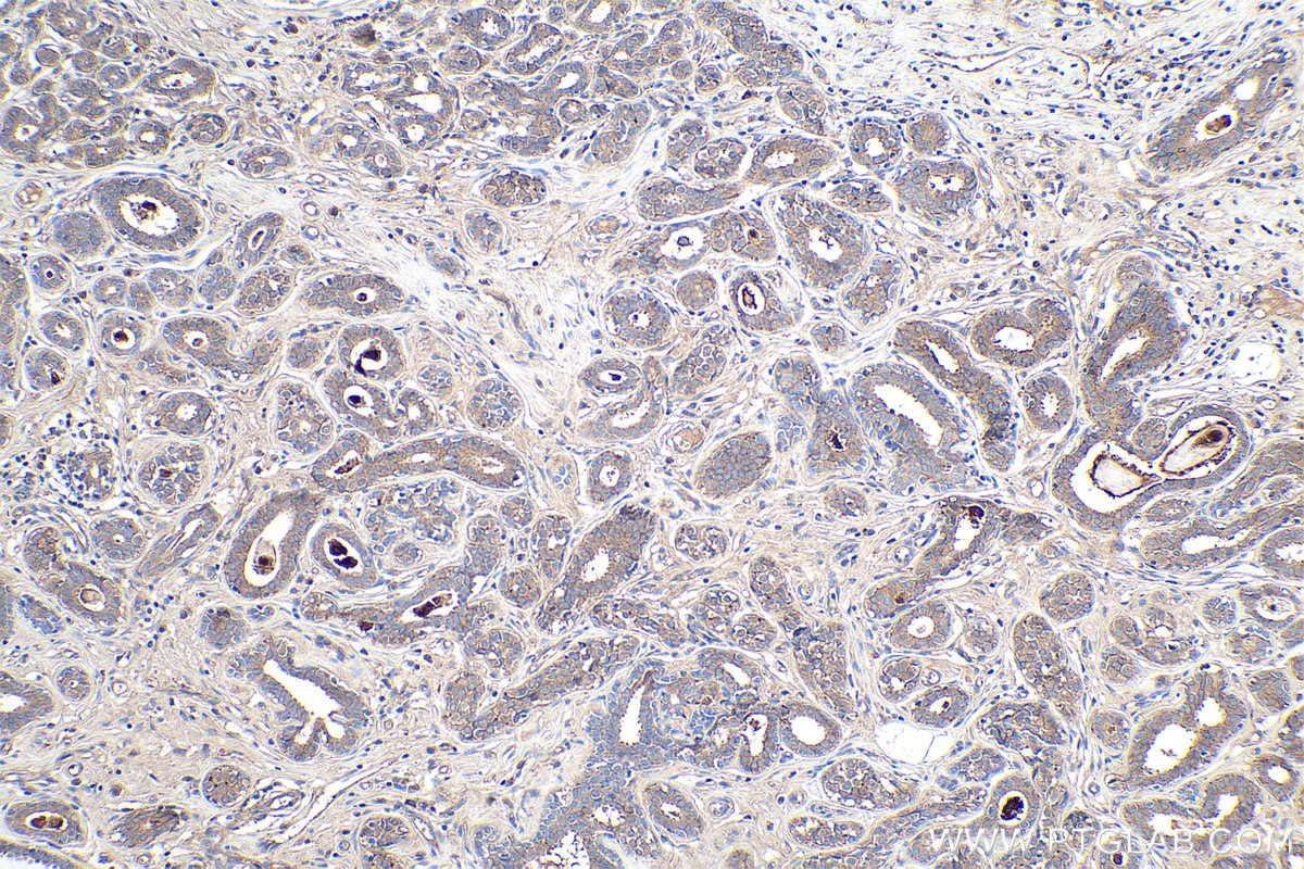 Immunohistochemistry (IHC) staining of human breast cancer tissue using Nectin-2/PVRL2 Polyclonal antibody (27171-1-AP)