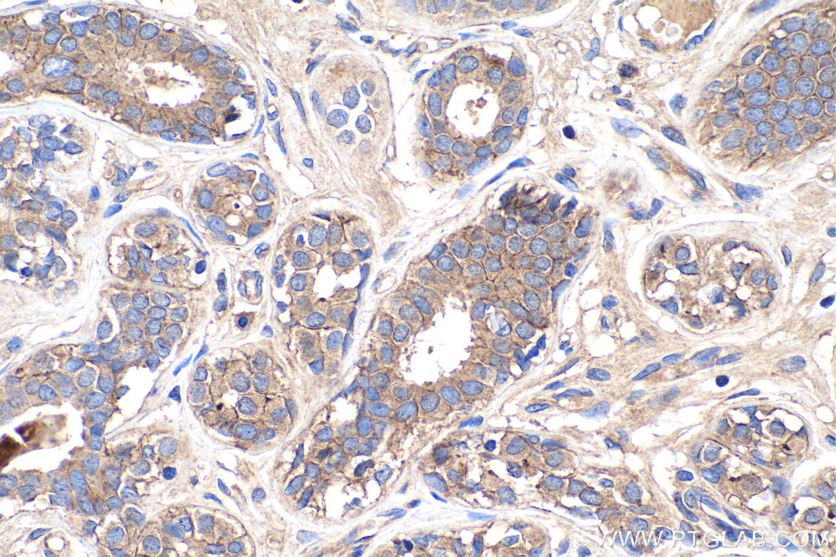 Immunohistochemistry (IHC) staining of human breast cancer tissue using Nectin-2/PVRL2 Polyclonal antibody (27171-1-AP)