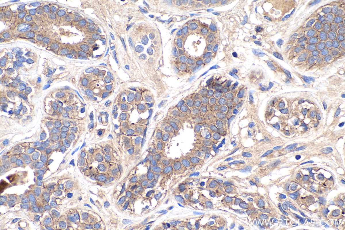 IHC staining of human breast cancer using 27171-1-AP