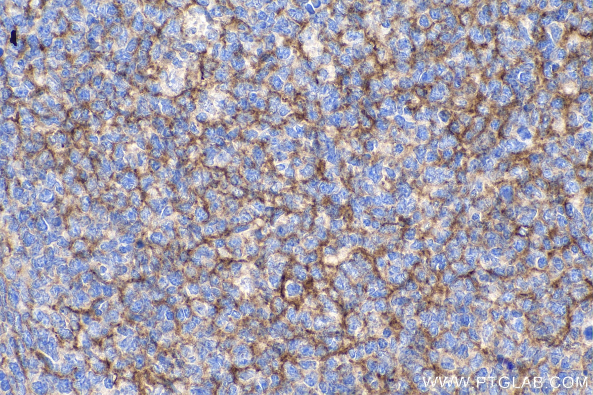 Immunohistochemistry (IHC) staining of human tonsillitis tissue using Nectin-2/PVRL2 Polyclonal antibody (27171-1-AP)