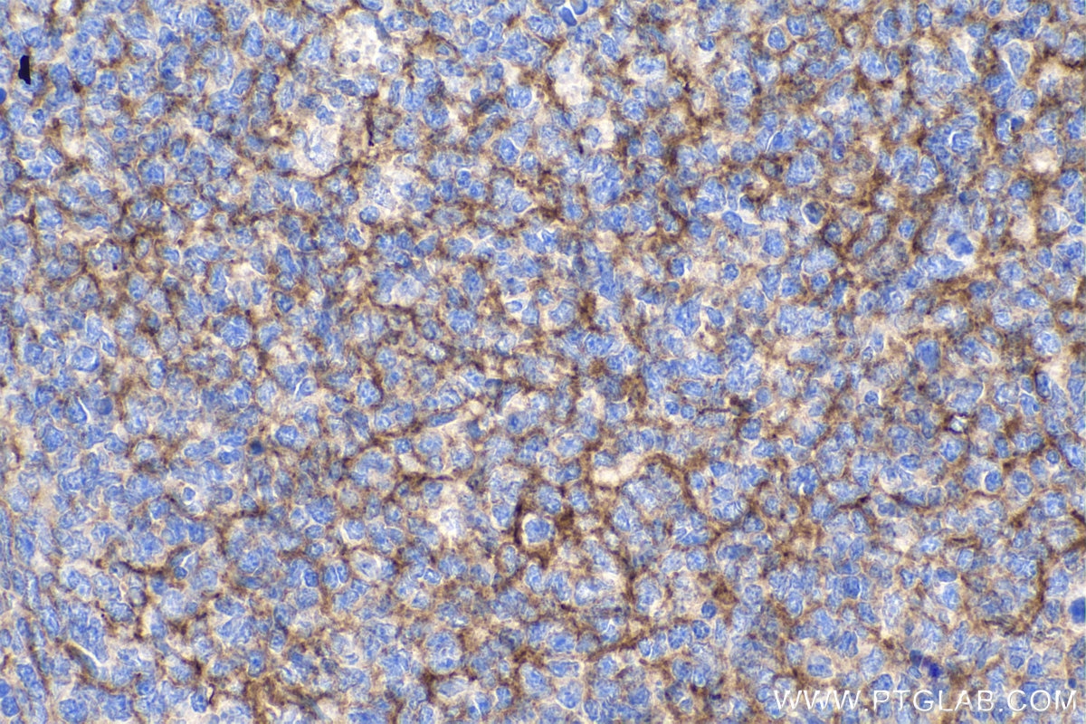 IHC staining of human tonsillitis using 27171-1-AP