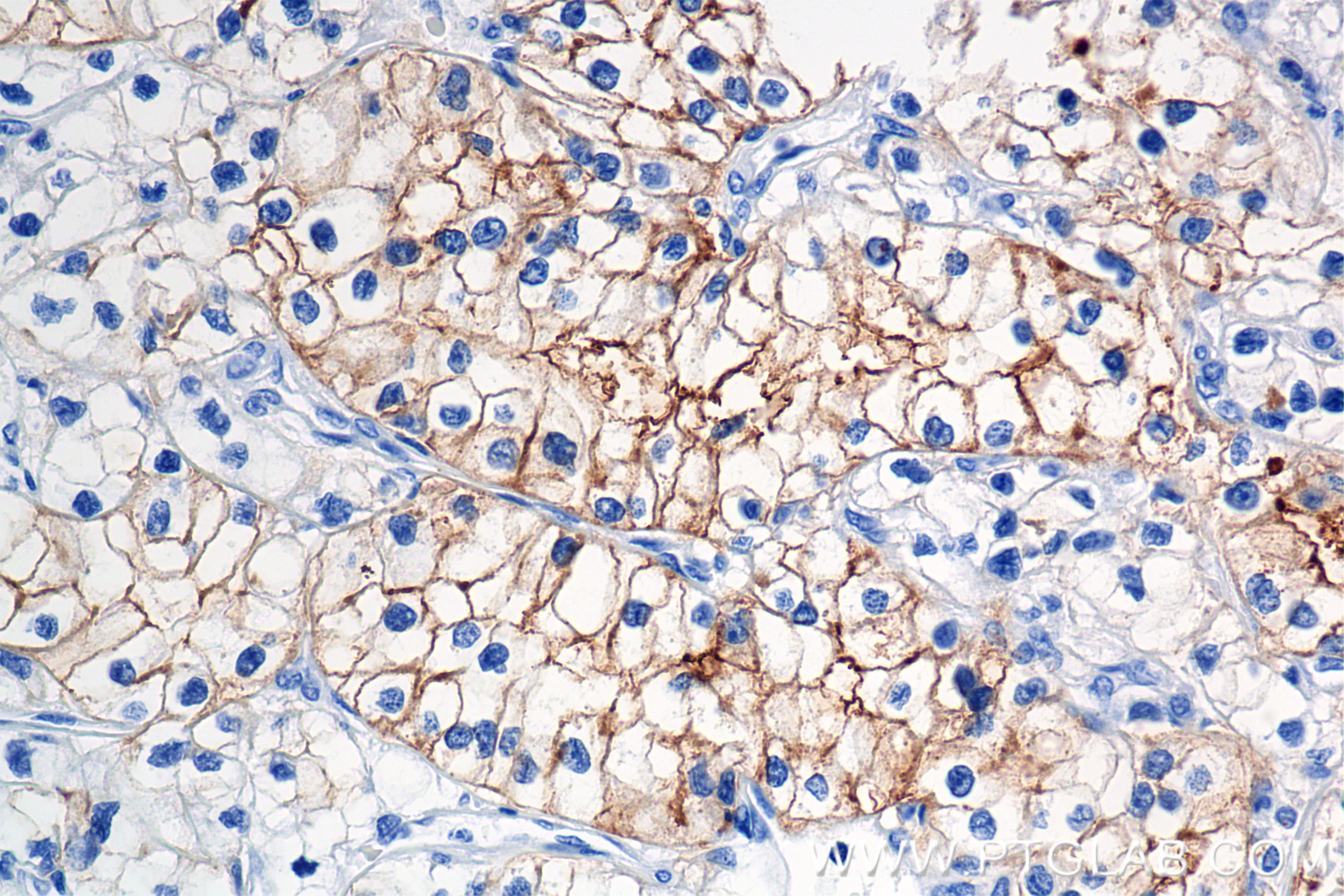 Immunohistochemistry (IHC) staining of Human Kidney(renal cell) Cancer using Neprilysin/CD10 Recombinant antibody (84181-1-RR)