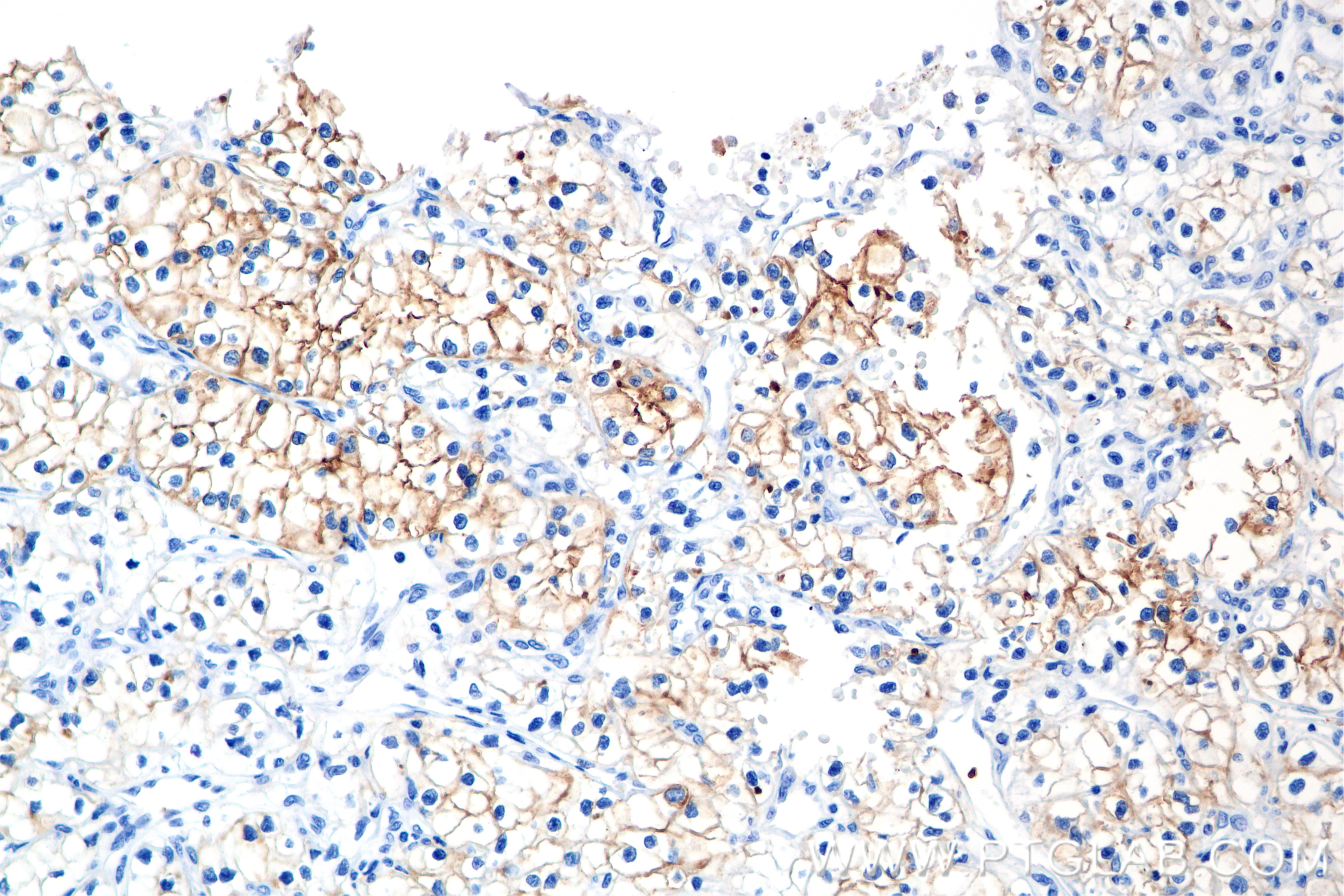Immunohistochemistry (IHC) staining of Human Kidney(renal cell) Cancer using Neprilysin/CD10 Recombinant antibody (84181-1-RR)