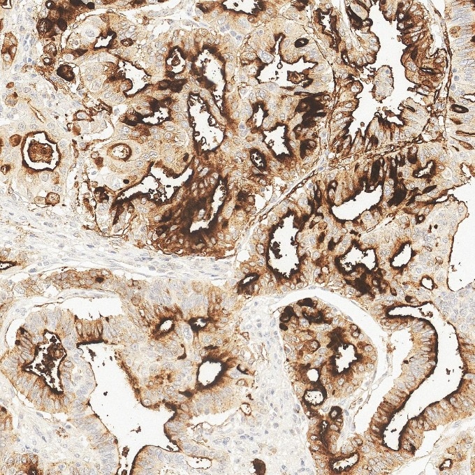 IHC staining of human pancreas cancer using 84181-1-RR Immunohistochemistry (IHC) staining of human pancreas cancer tissue using Neprilysin/CD10 Recombinant monoclonal antibody (84181-1-RR)
