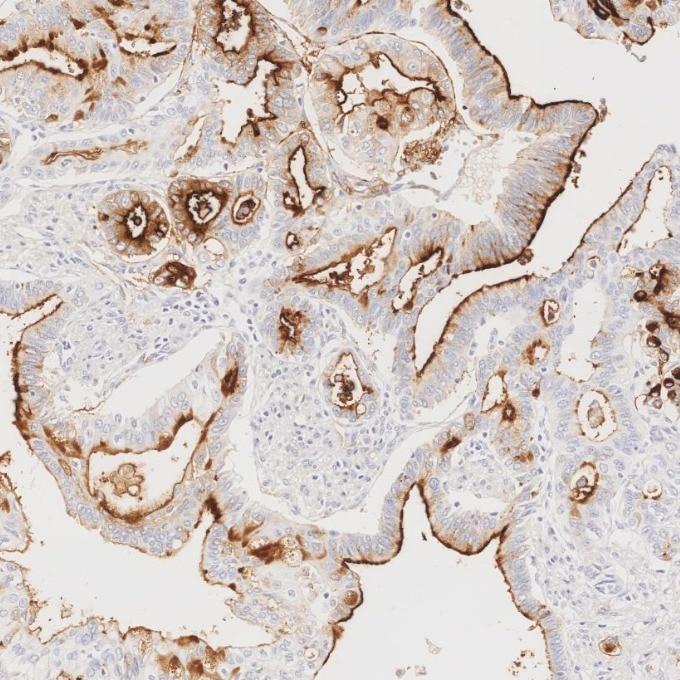 IHC staining of human pancreas cancer using 84181-1-RR Immunohistochemistry (IHC) staining of human pancreas cancer tissue using Neprilysin/CD10 Recombinant monoclonal antibody (84181-1-RR)
