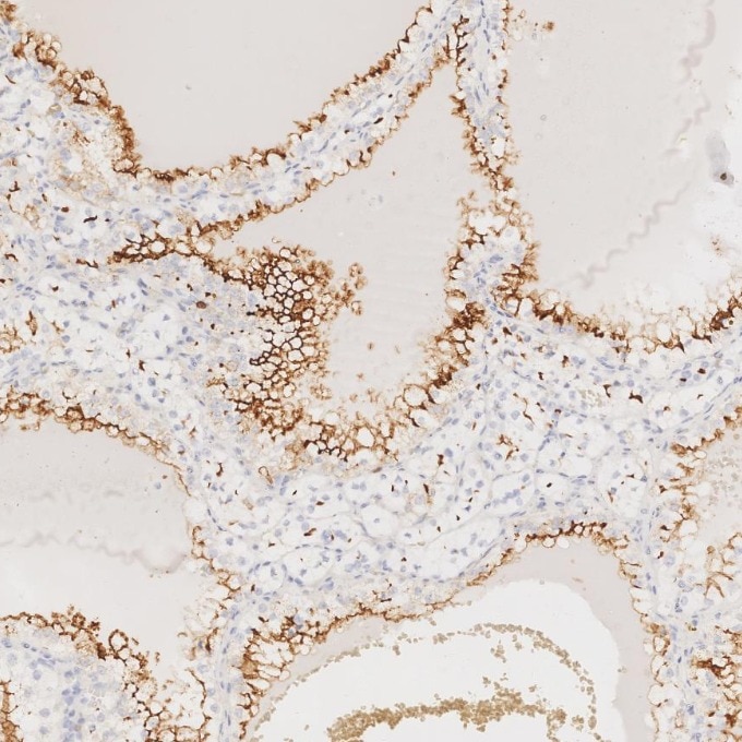 IHC staining of human renal cell carcinoma using 84181-1-RR Immunohistochemistry (IHC) staining of human renal cell carcinoma tissue using Neprilysin/CD10 Recombinant monoclonal antibody (84181-1-RR)