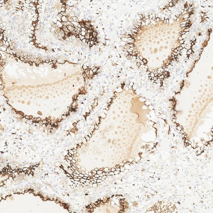 IHC staining of human renal cell carcinoma using 84181-1-RR Immunohistochemistry (IHC) staining of human renal cell carcinoma tissue using Neprilysin/CD10 Recombinant monoclonal antibody (84181-1-RR)