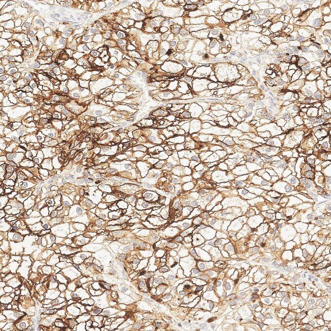 IHC staining of human renal cell carcinoma using 84181-1-RR Immunohistochemistry (IHC) staining of human renal cell carcinoma tissue using Neprilysin/CD10 Recombinant monoclonal antibody (84181-1-RR)