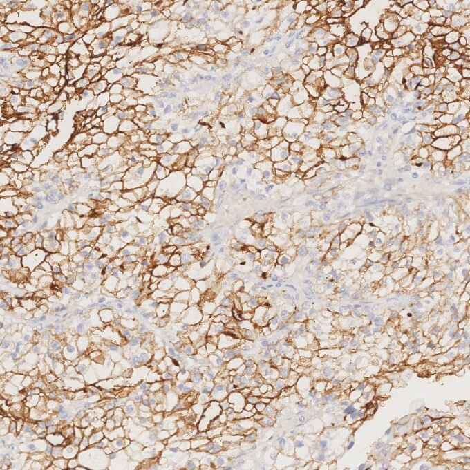 IHC staining of human renal cell carcinoma using 84181-1-RR Immunohistochemistry (IHC) staining of human renal cell carcinoma tissue using Neprilysin/CD10 Recombinant monoclonal antibody (84181-1-RR)