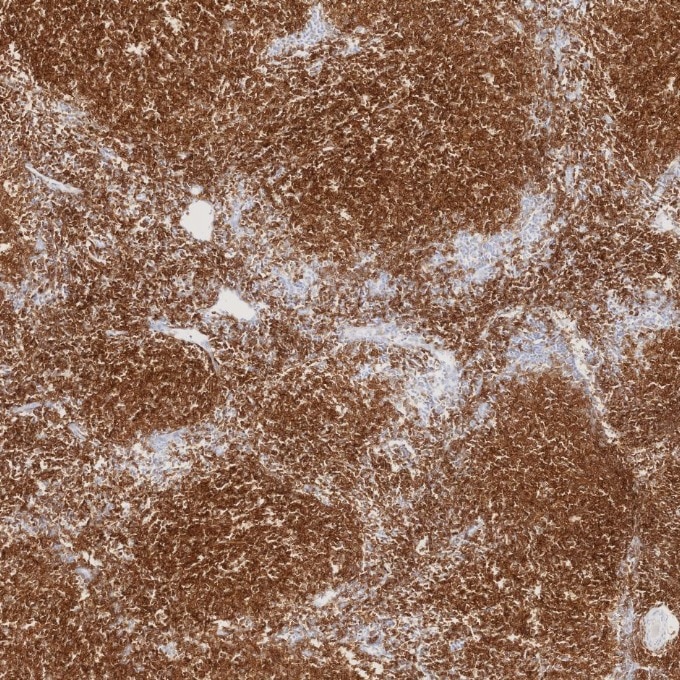 IHC staining of human lymphoma using 84181-1-RR Immunohistochemistry (IHC) staining of human lymphoma tissue using Neprilysin/CD10 Recombinant monoclonal antibody (84181-1-RR)