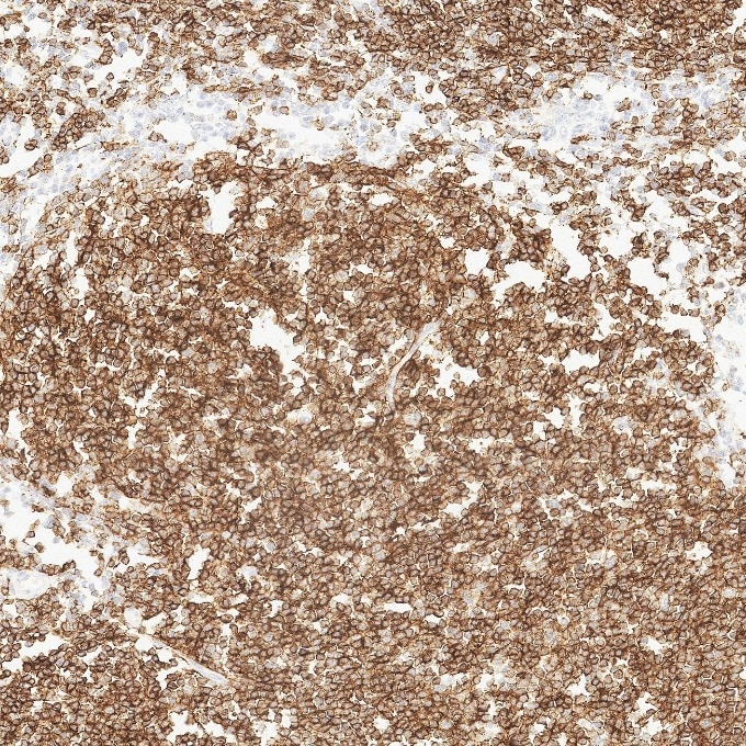 IHC staining of human lymphoma using 84181-1-RR Immunohistochemistry (IHC) staining of human lymphoma tissue using Neprilysin/CD10 Recombinant monoclonal antibody (84181-1-RR)