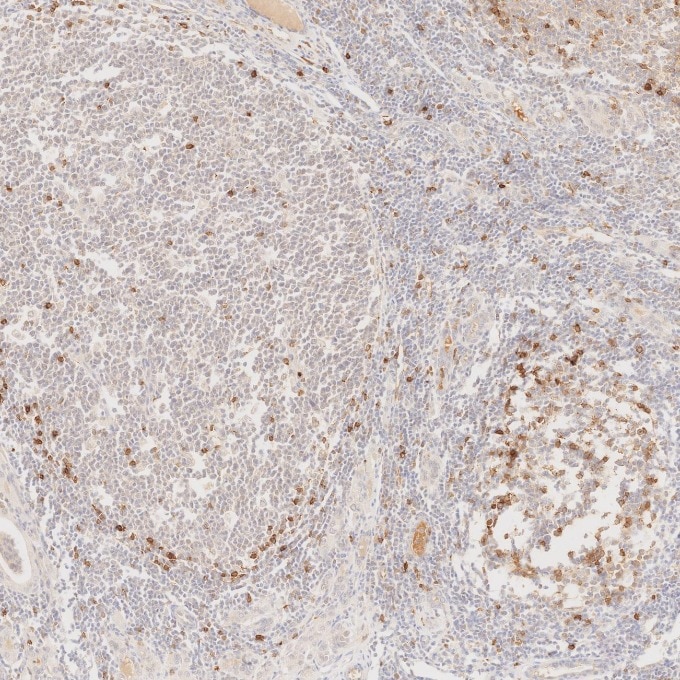 IHC staining of human lymphoma using 84181-1-RR Immunohistochemistry (IHC) staining of human lymphoma tissue using Neprilysin/CD10 Recombinant monoclonal antibody (84181-1-RR)
