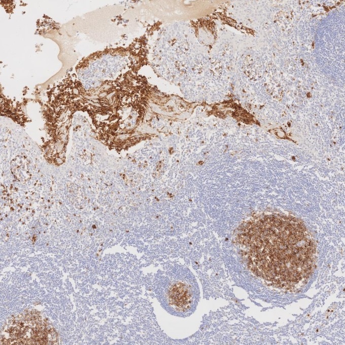 IHC staining of human tonsillitis using 84181-1-RR Immunohistochemistry (IHC) staining of human tonsillitis tissue using Neprilysin/CD10 Recombinant monoclonal antibody (84181-1-RR)