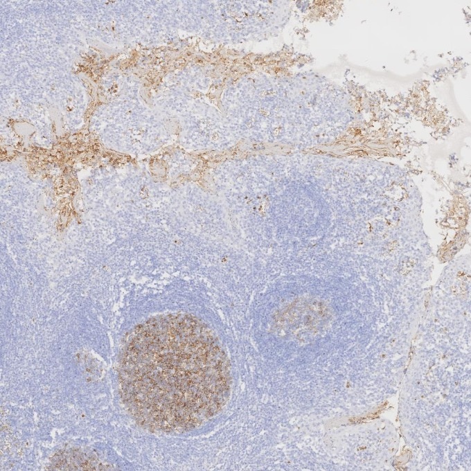 IHC staining of human tonsillitis using 84181-1-RR Immunohistochemistry (IHC) staining of human tonsillitis tissue using Neprilysin/CD10 Recombinant monoclonal antibody (84181-1-RR)