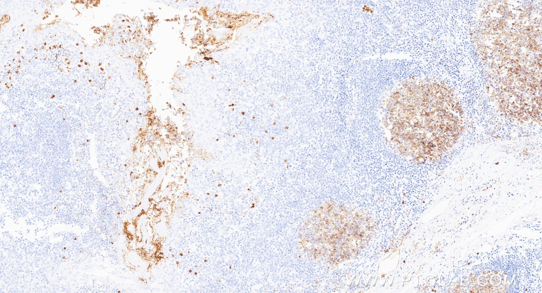 Immunohistochemistry (IHC) staining of human tonsillitis tissue using Neprilysin/CD10 Recombinant monoclonal antibody (84181-5-RR)