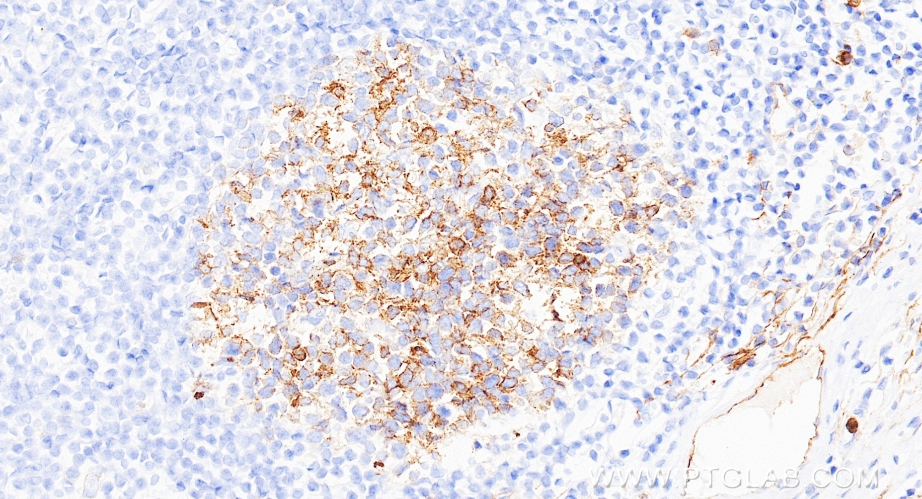 Immunohistochemistry (IHC) staining of human tonsillitis tissue using Neprilysin/CD10 Recombinant monoclonal antibody (84181-5-RR)