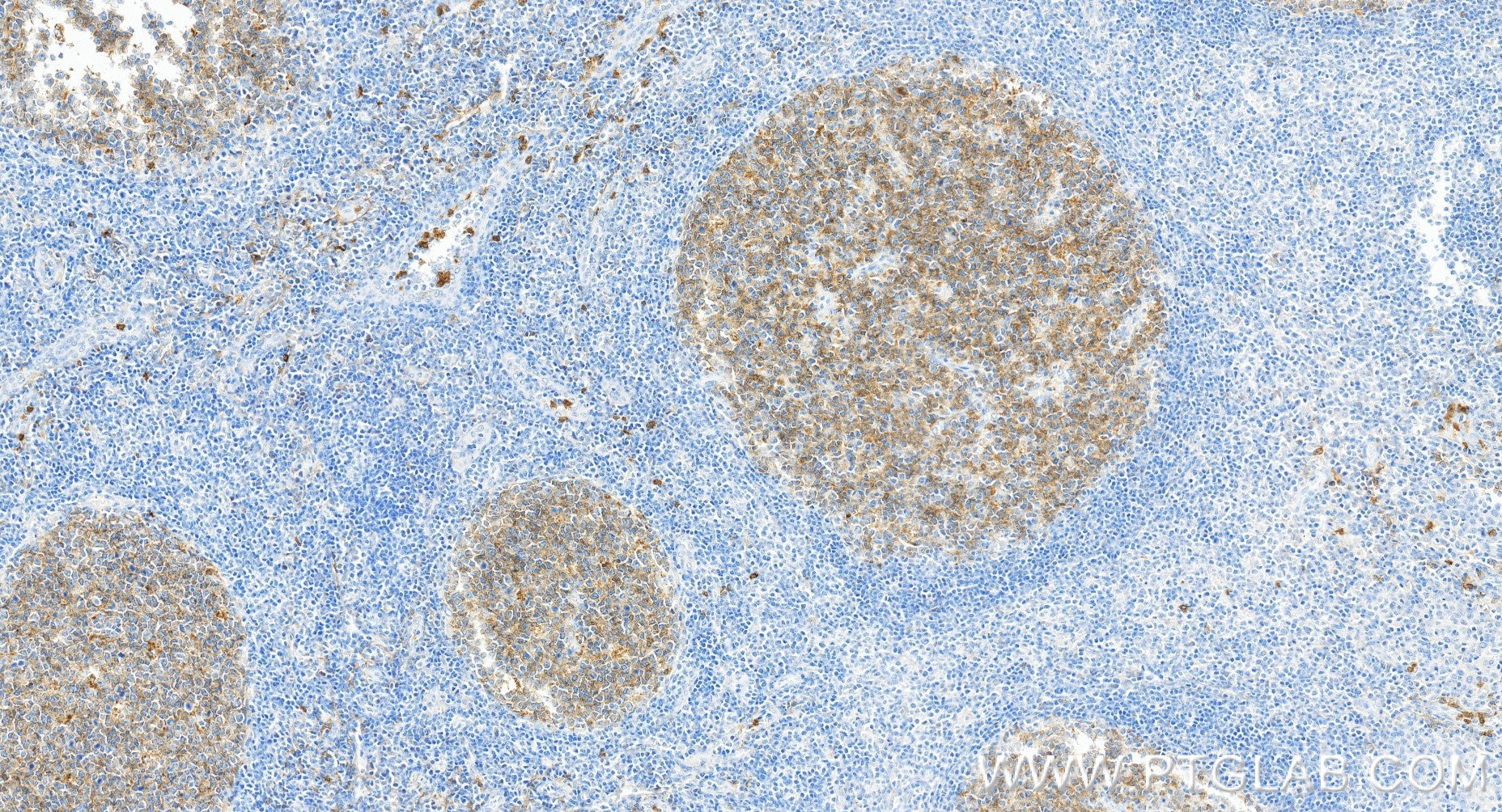 Immunohistochemistry (IHC) staining of human tonsillitis tissue using Neprilysin/CD10 Recombinant monoclonal antibody (84181-5-RR)