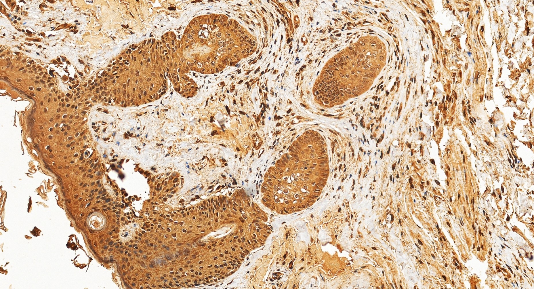 Immunohistochemistry (IHC) staining of human skin squamous cell cancer tissue using Nesprin1/Syne-1 Polyclonal antibody (31095-1-AP)