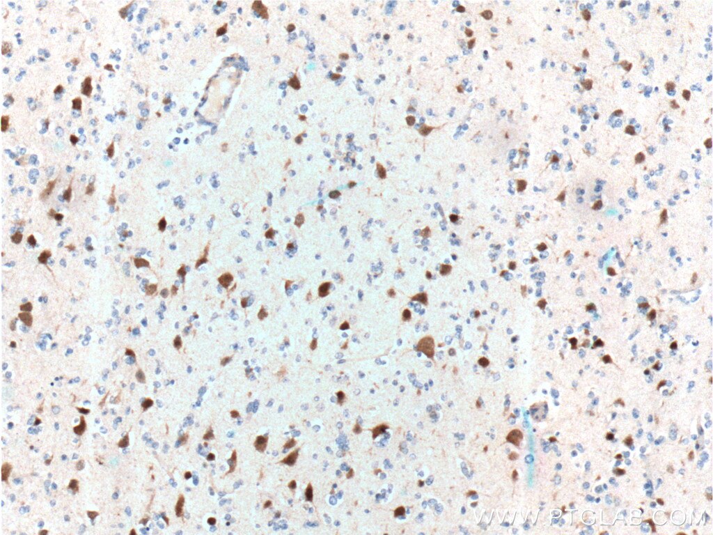 IHC staining of human gliomas using 26975-1-AP