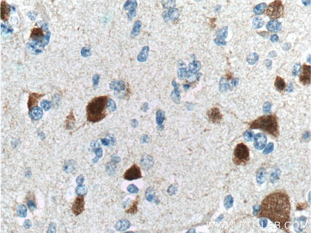 IHC staining of human gliomas using 26975-1-AP