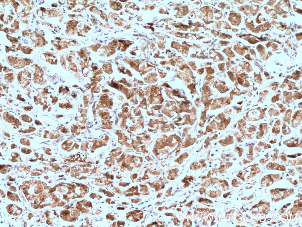 Immunohistochemistry (IHC) staining of human breast cancer tissue using Neurofibromin 1 Polyclonal antibody (27249-1-AP)