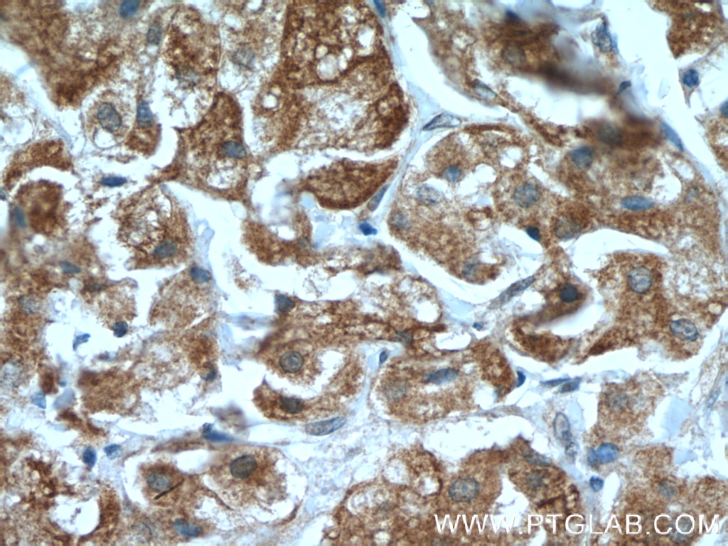 Immunohistochemistry (IHC) staining of human breast cancer tissue using Neurofibromin 1 Polyclonal antibody (27249-1-AP)
