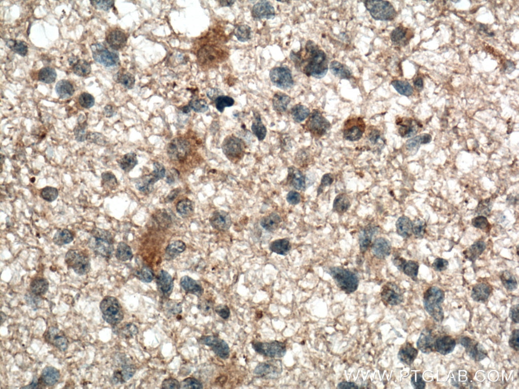 Immunohistochemistry (IHC) staining of human gliomas tissue using Neuromedin B Monoclonal antibody (66781-1-Ig)