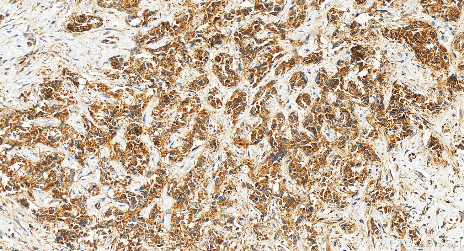 Immunohistochemistry (IHC) staining of human intrahepatic cholangiocarcinoma tissue using Neuropilin 2 Polyclonal antibody (27193-1-AP)
