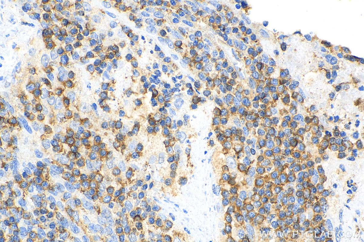 Immunohistochemistry (IHC) staining of human tonsillitis tissue using NeutraKine® IL-10 Monoclonal antibody (69018-1-Ig)