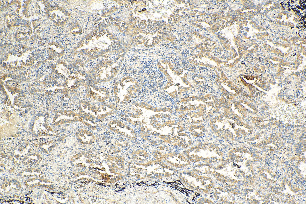 IHC staining of human lung cancer using 69018-1-Ig