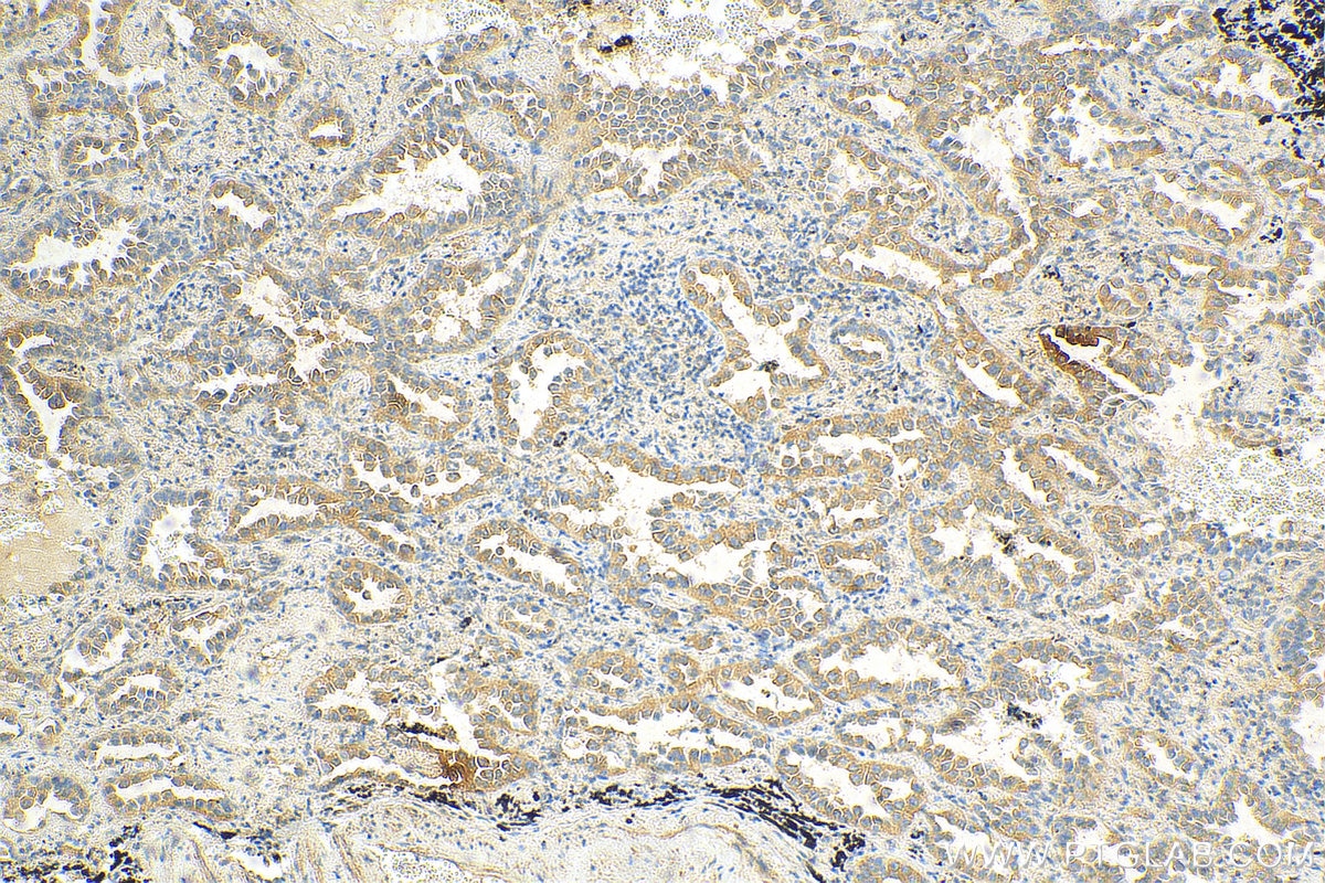 Immunohistochemistry (IHC) staining of human lung cancer tissue using NeutraKine® IL-10 Monoclonal antibody (69018-1-Ig)