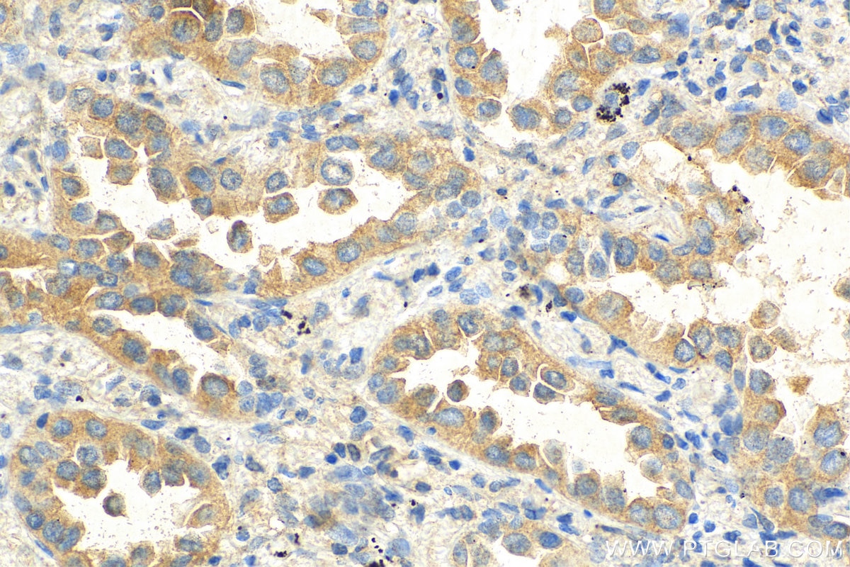 Immunohistochemistry (IHC) staining of human lung cancer tissue using NeutraKine® IL-10 Monoclonal antibody (69018-1-Ig)
