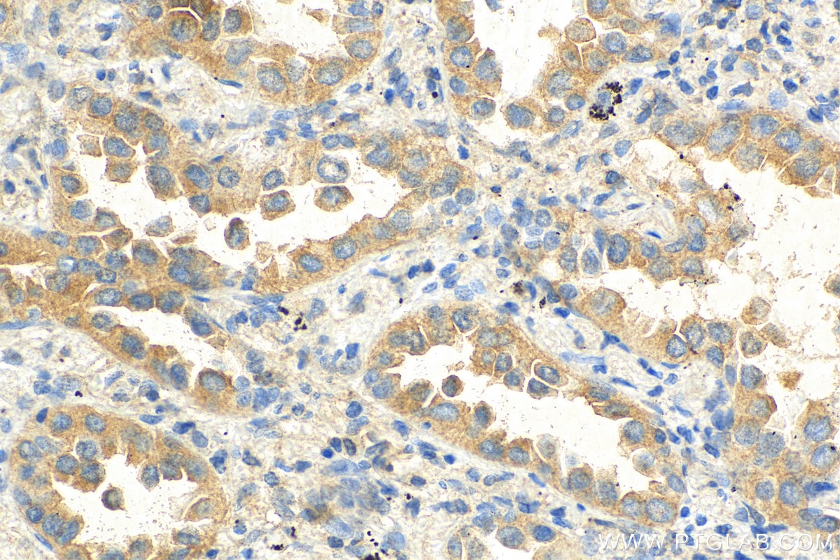 IHC staining of human lung cancer using 69018-1-Ig