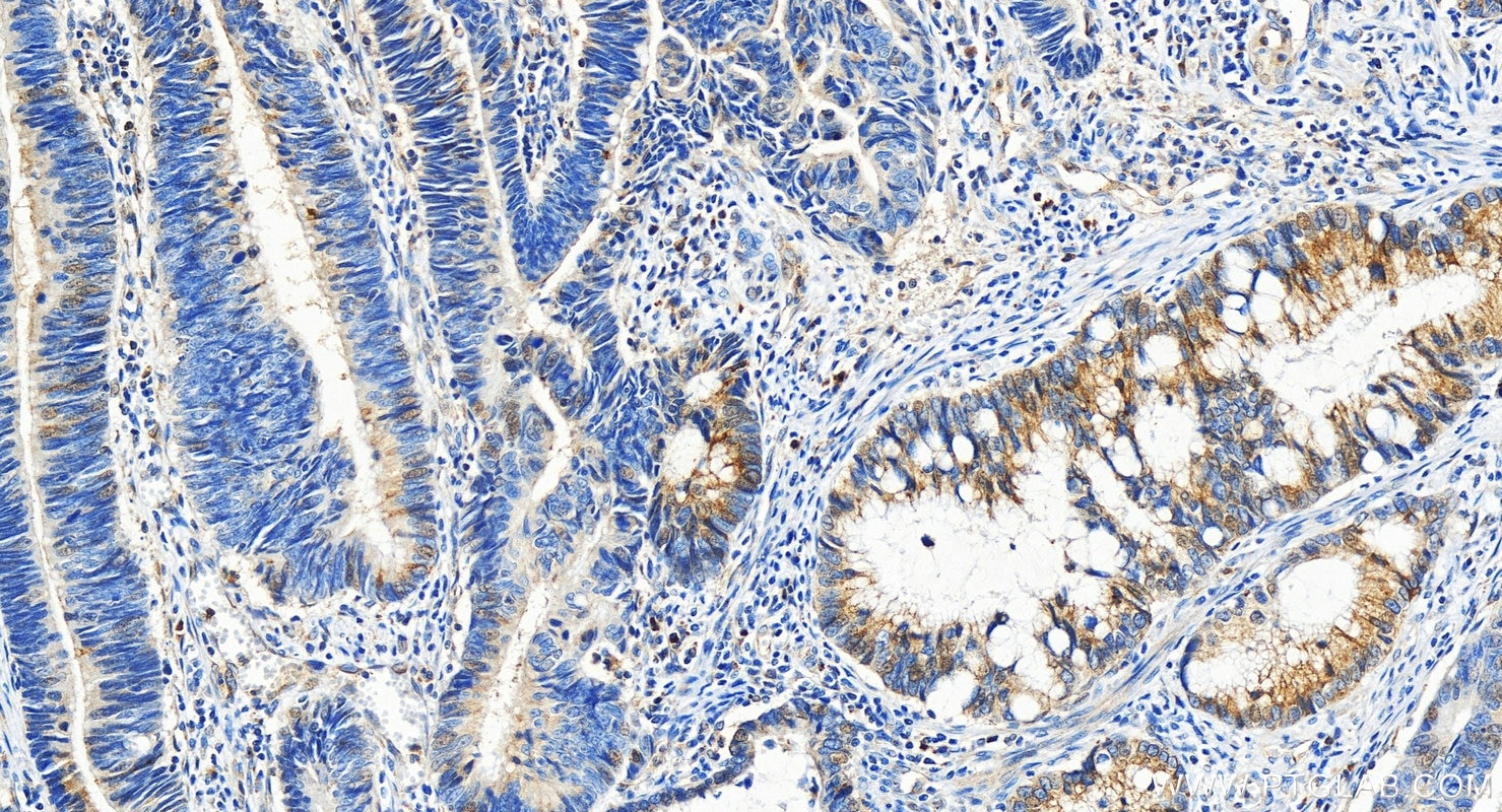 Immunohistochemistry (IHC) staining of human colon cancer tissue using NUCB2/nesfatin-1 Polyclonal antibody (26712-1-AP)