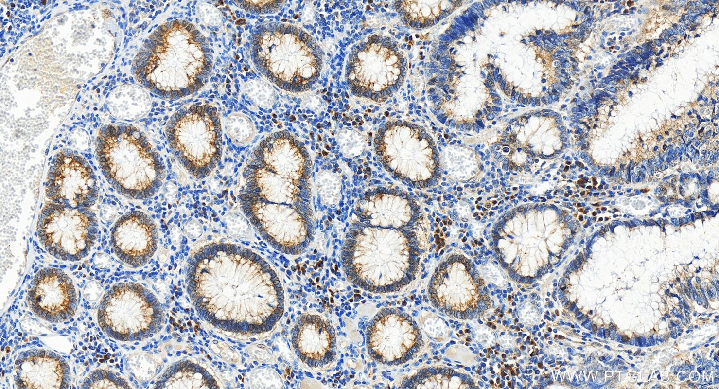 Immunohistochemistry (IHC) staining of human colon cancer tissue using NUCB2/nesfatin-1 Polyclonal antibody (26712-1-AP)