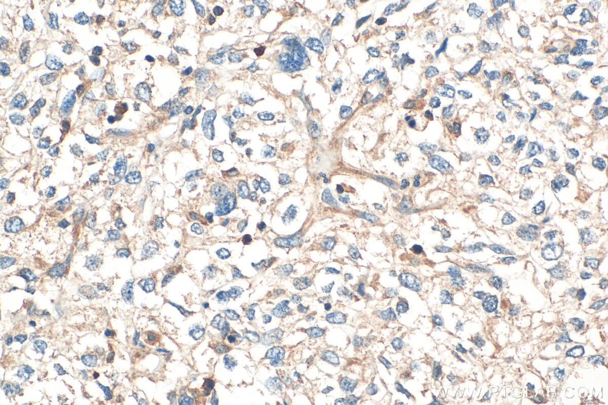 Immunohistochemistry (IHC) staining of human pancreas cancer tissue using OAS1/3 Polyclonal antibody (14955-1-AP)