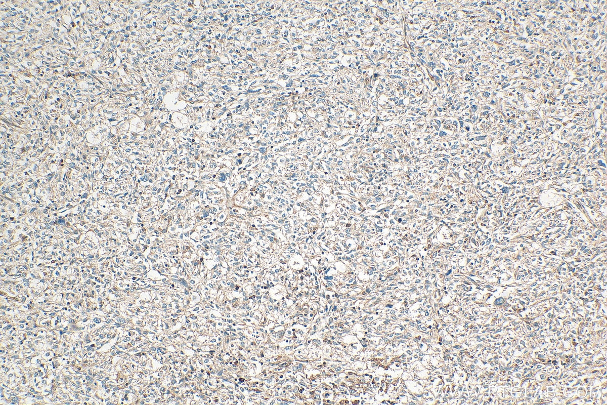 Immunohistochemistry (IHC) staining of human pancreas cancer tissue using OAS1/3 Polyclonal antibody (14955-1-AP)
