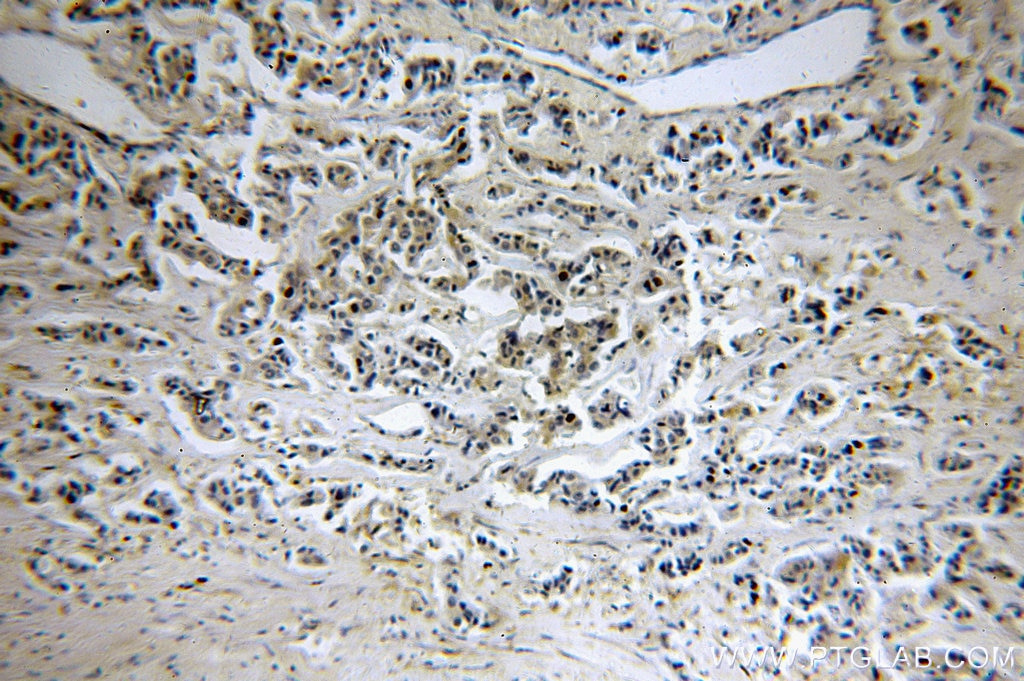 Immunohistochemistry (IHC) staining of human breast cancer tissue using OAS2 Polyclonal antibody (14214-1-AP)