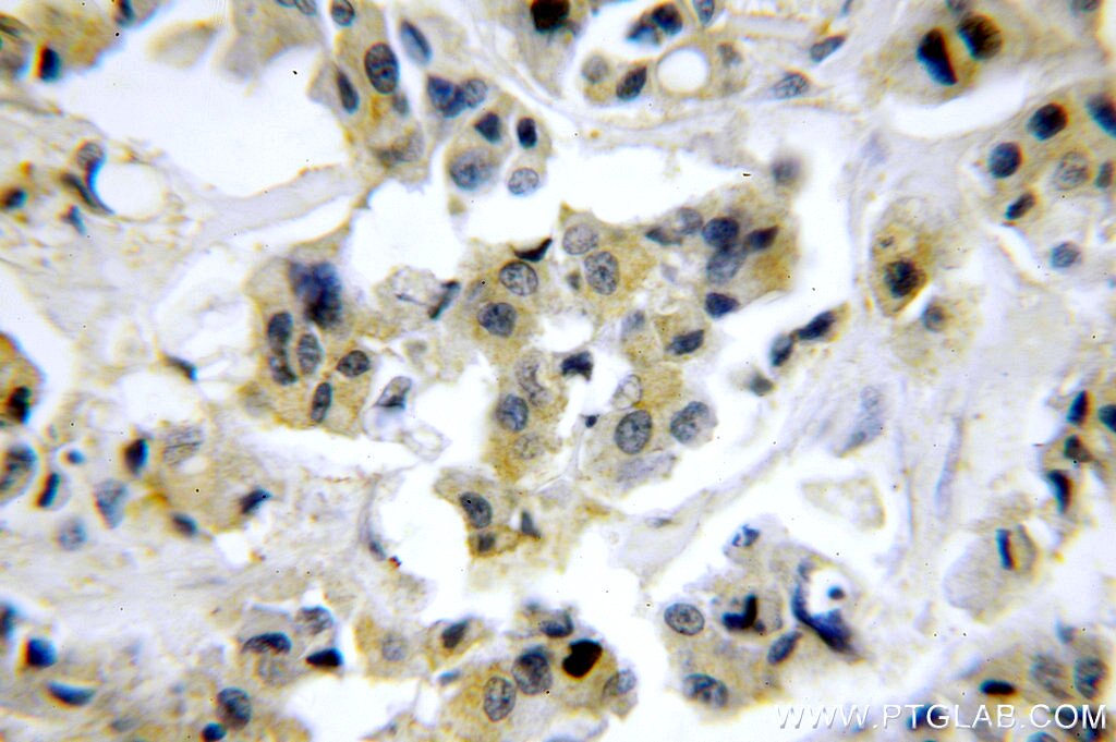 Immunohistochemistry (IHC) staining of human breast cancer tissue using OAS2 Polyclonal antibody (14214-1-AP)