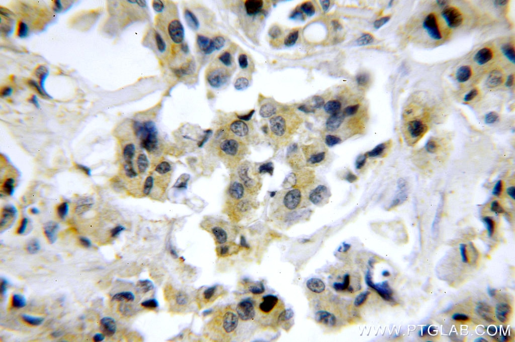 Immunohistochemistry (IHC) staining of human breast cancer tissue using OAS2 Polyclonal antibody (14214-1-AP)