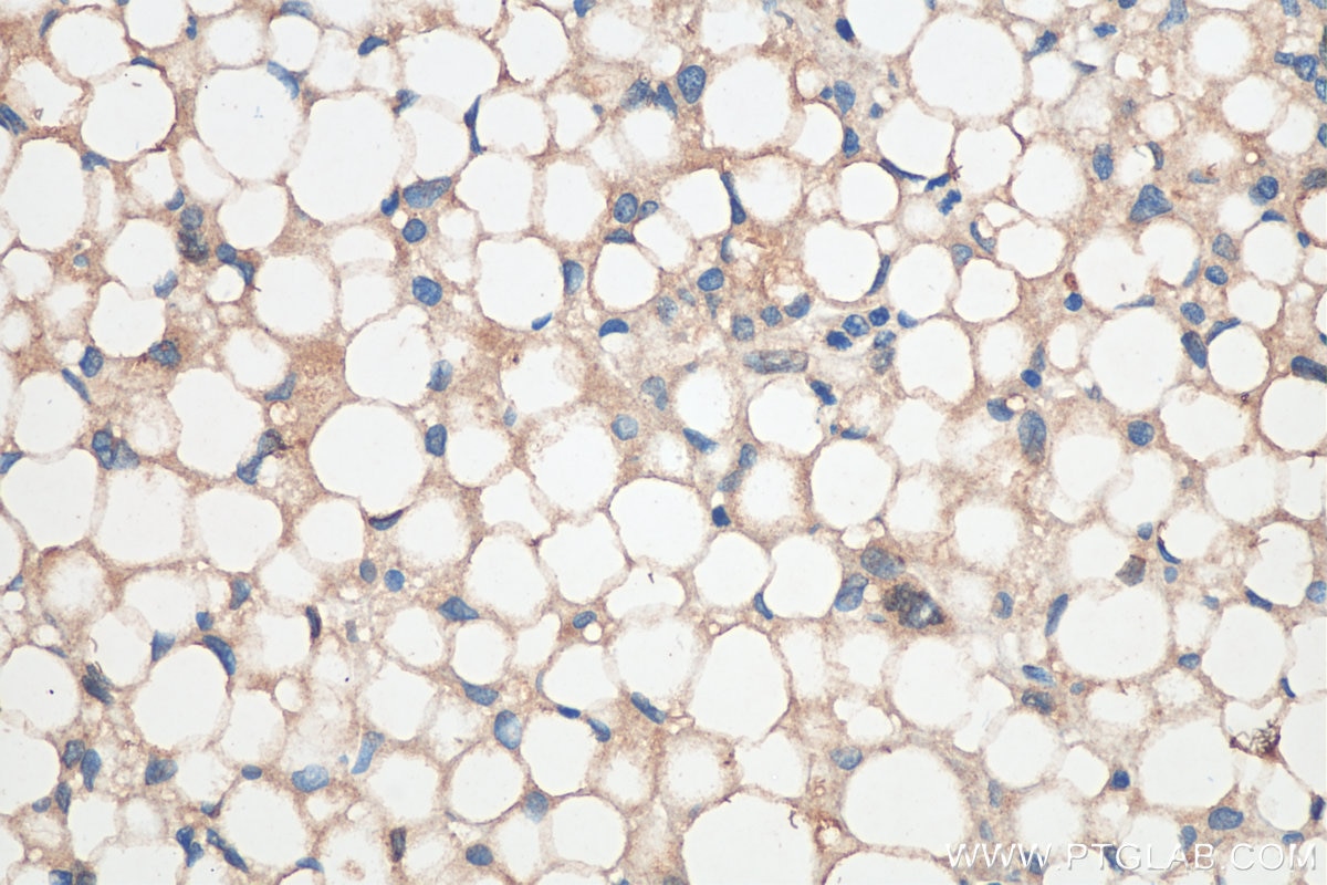 Immunohistochemistry (IHC) staining of human liver cancer tissue using OAS2 Polyclonal antibody (19279-1-AP)