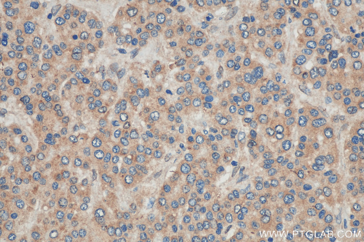 Immunohistochemistry (IHC) staining of human liver cancer tissue using OAS2 Polyclonal antibody (19279-1-AP)