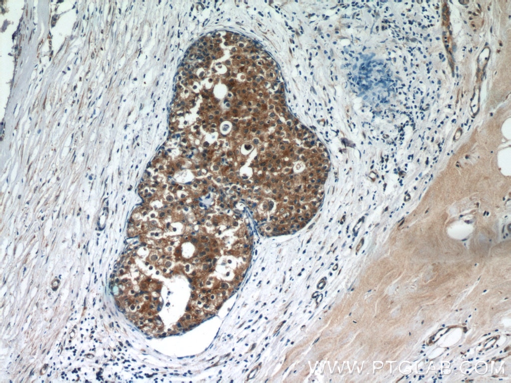 IHC staining of human breast cancer using 19279-1-AP