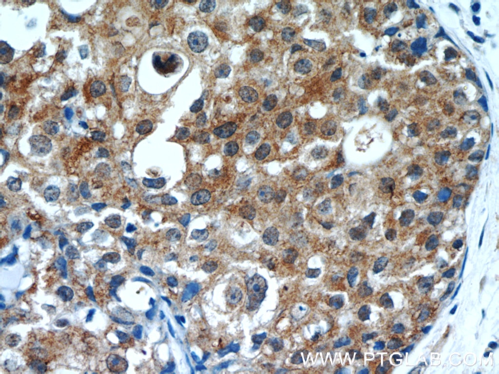 Immunohistochemistry (IHC) staining of human breast cancer tissue using OAS2 Polyclonal antibody (19279-1-AP)