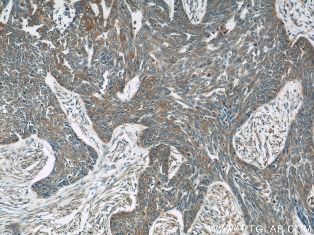 Immunohistochemistry (IHC) staining of human skin cancer tissue using OAS3 Polyclonal antibody (21915-1-AP)