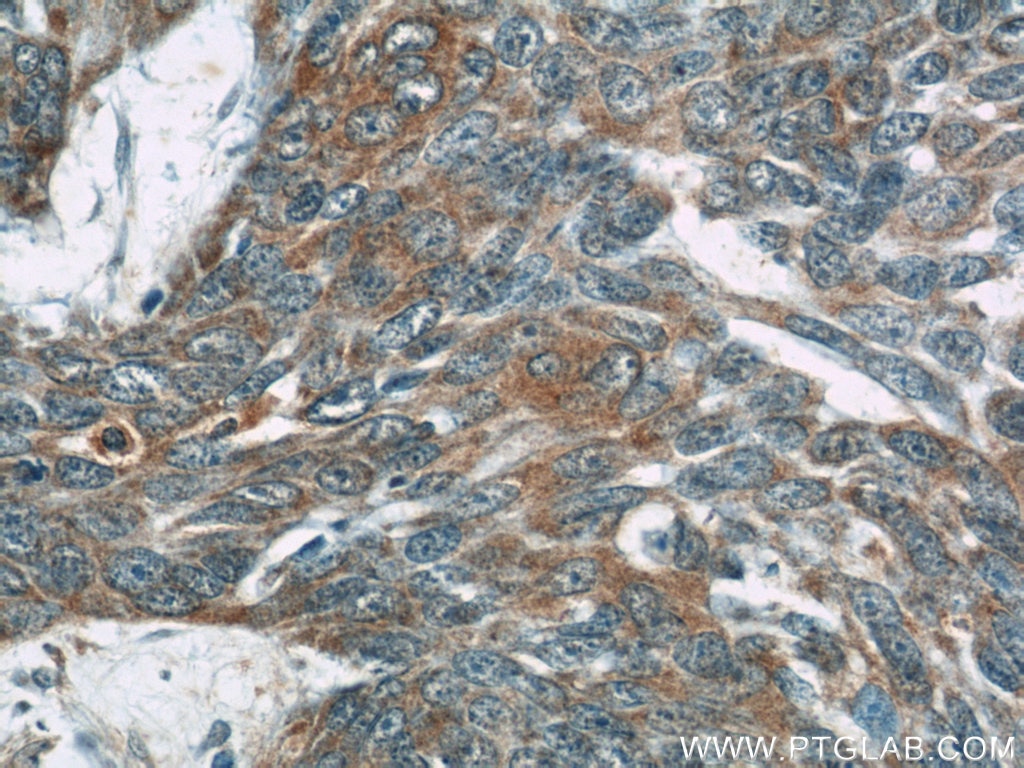 Immunohistochemistry (IHC) staining of human skin cancer tissue using OAS3 Polyclonal antibody (21915-1-AP)